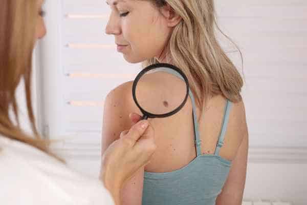What Are Traditional Skin Lesion Removal Methods Walthamstow?