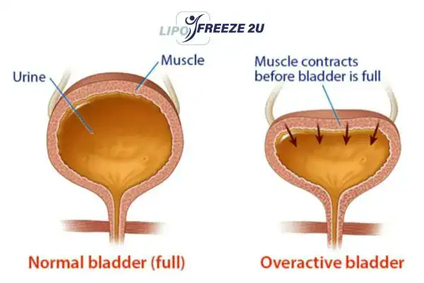 diagram of overactive bladder treatment Walthamstow