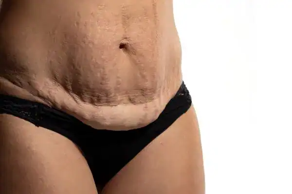 loose skin after weight loss injections Walthamstow