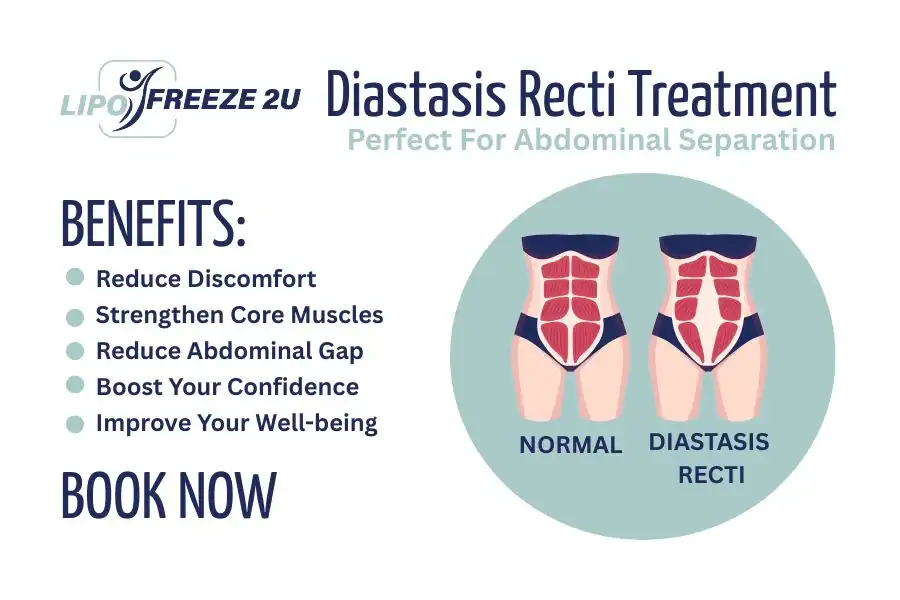 How Long Will It Take to See Improvements in Diastasis Recti Walthamstow