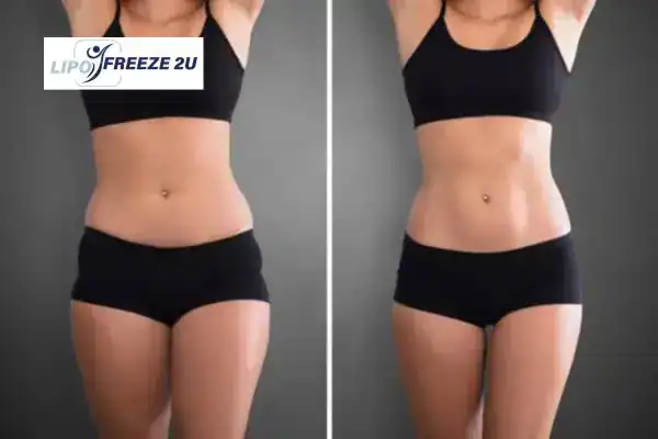 How Can LIPO FREEZE 2U Support Your Post-Pregnancy Body Recovery Walthamstow?