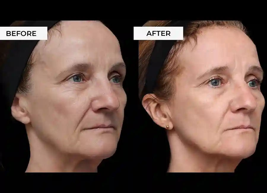 How Many RF Microneedling Sessions Will You Need to See a Difference Walthamstow?